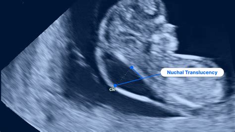 Nuchal Fold Ultrasound