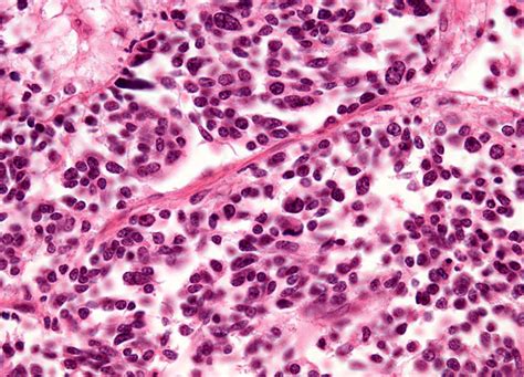 Oat Cell Carcinoma