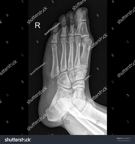 Oblique Foot Xray Anatomy