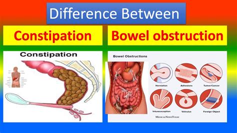 Obstipation Vs Constipation