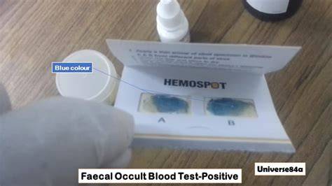 Occult Blood Positive