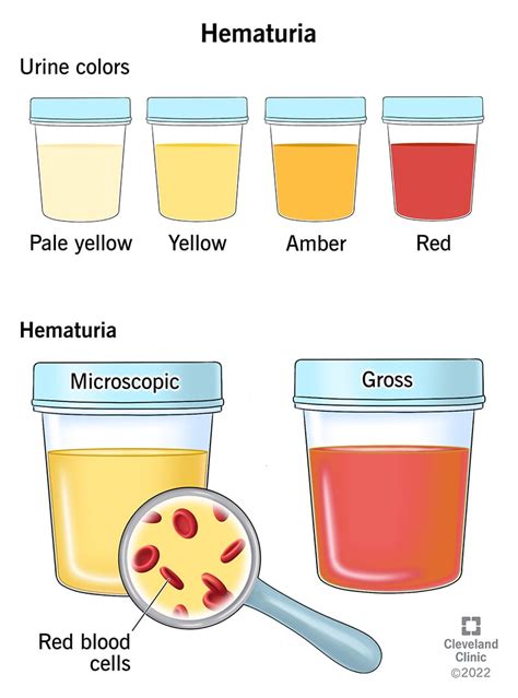 Occult Blood Urine