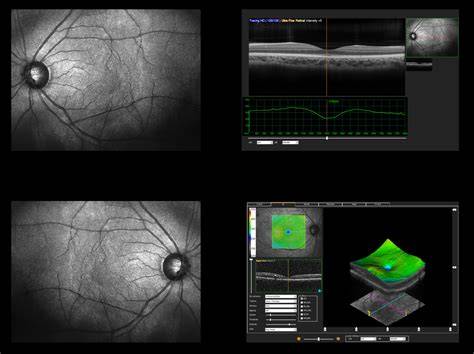 Oct Eye Exam