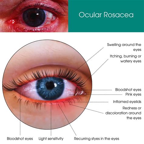 Ocular Rosacea Treatment