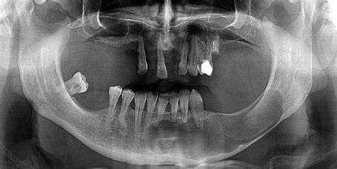 Odontogenic Keratocystic Tumor