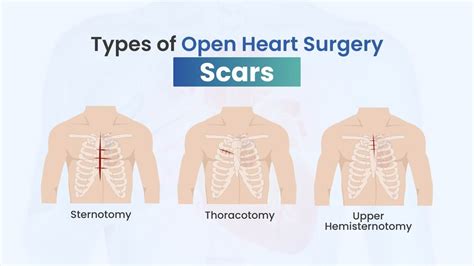 Open Heart Surgery Scar