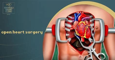 Open Heart Surgery Video