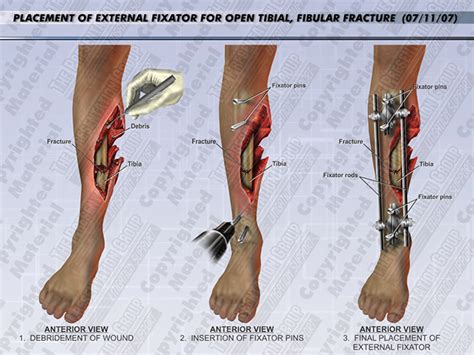 Open Reduction Internal Fixation