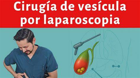 Operacion De Vesicula