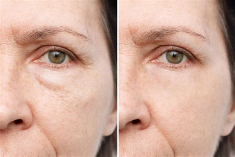 Operation For Bags Under Eyes