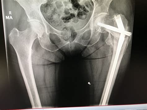 Operation For Broken Hip