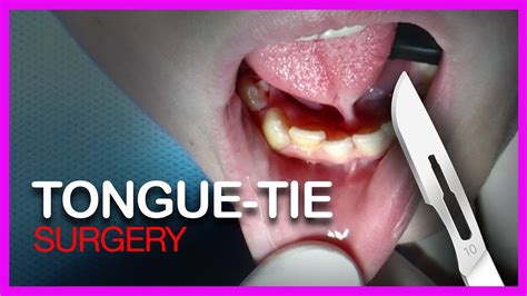 Operation Tongue Tie