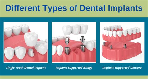 Options For Dental Implants