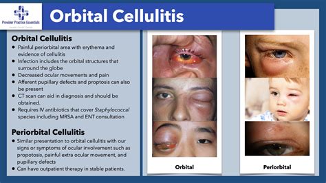 Orbital Cellulitis Stages