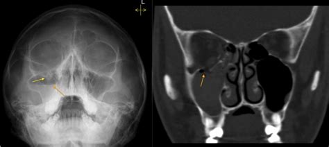 Orbital Floor Fracture