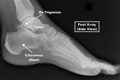 Os Trigonum Syndrome
