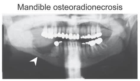 Osteoradionecrosis Of The Jaw