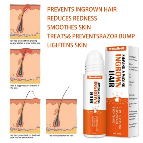 Otc Cream For Ingrown Hair