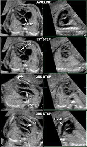 Outflow Tracts On Ultrasound