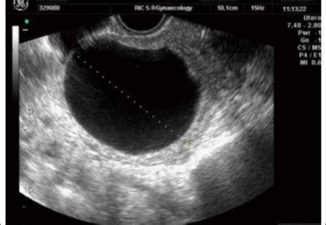 Ovarian Cyst Image Ultrasound