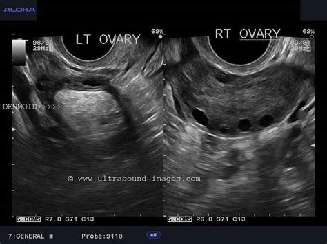 Ovary Normal Ultrasound