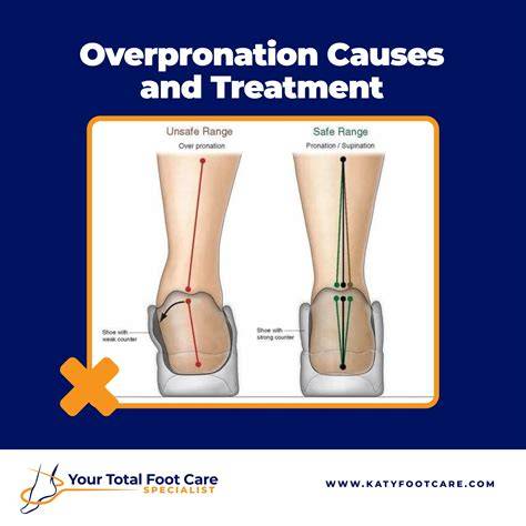 Over Pronation Of Foot