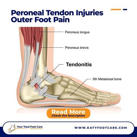 Pain Foot Outside