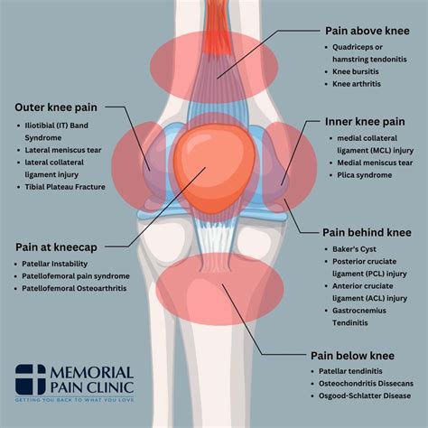Pain In Back Of Knee
