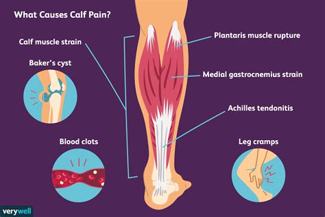 Pain In Calf
