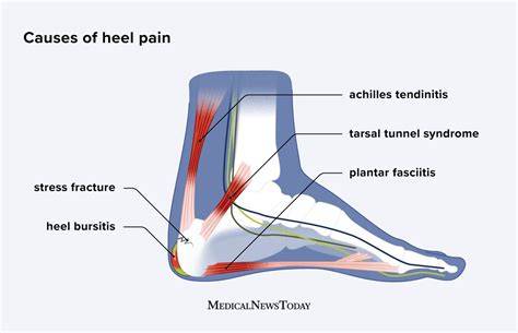 Pain In My Heel