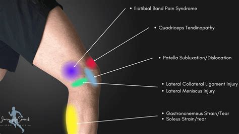 Pain On Outside Of Knee