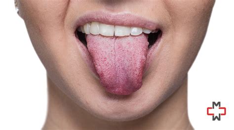 Painful Bumps On Tongue