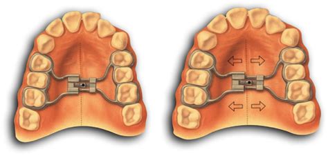Palate Widening Orthodontics
