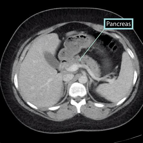 Pancreas On Ct