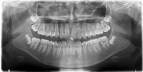 Panoramic Dental X Ray