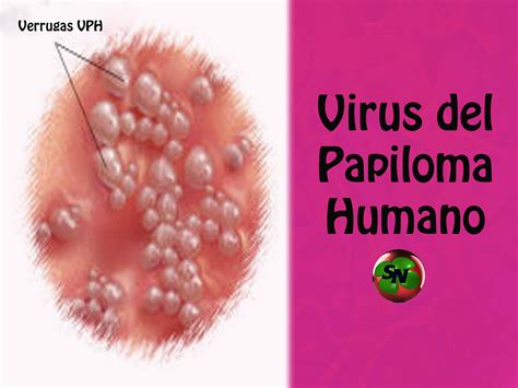 Papiloma Humano En Mujeres Fotos
