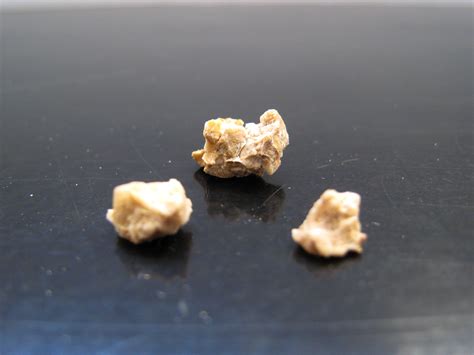 Passed Real Life Kidney Stones