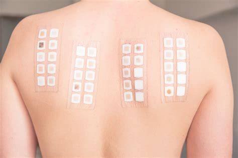Patch Test Allergy