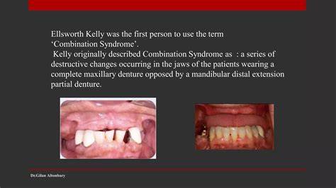 Patersonbrown Kelly Syndrome