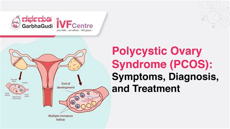 Pcos In Spanish