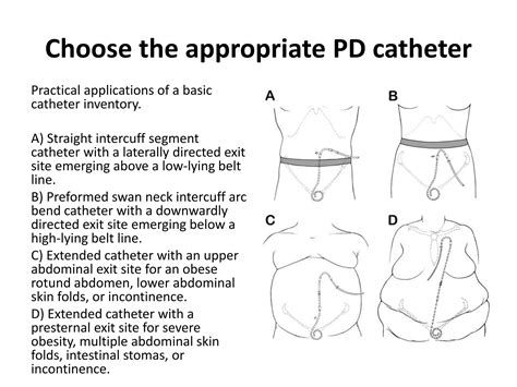 Pd Catheter Placement
