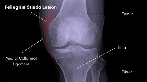 Pellegrini Stieda Lesion