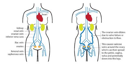 Pelvic Congestion Syndrome Symptoms