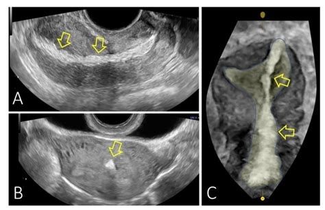 Perforation Of The Womb
