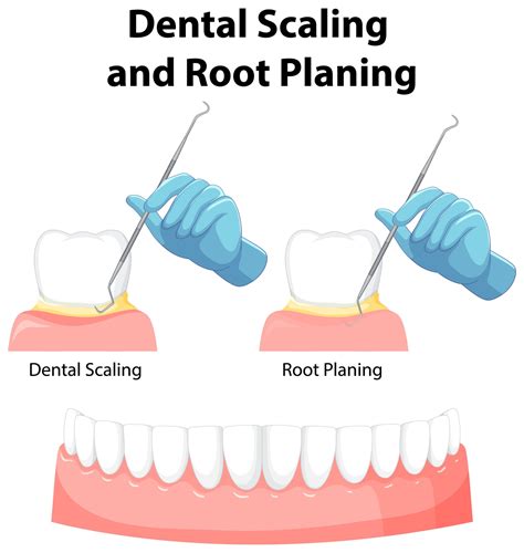 Periodontal Scaling And Root Planing