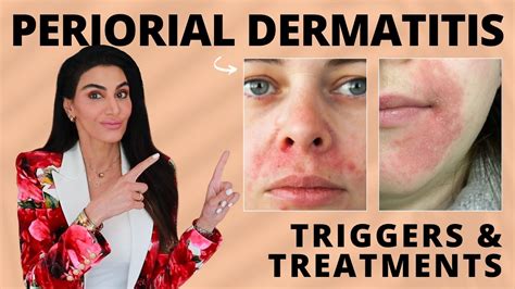 Perioral Dermatitis Treatments