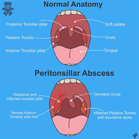 Peritonsillar Abscess Images