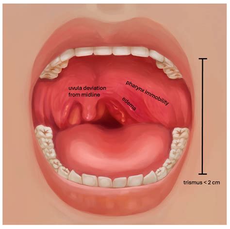 Peritonsillar Abscess Picture Image