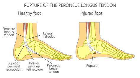 Peroneal Tendon Tear