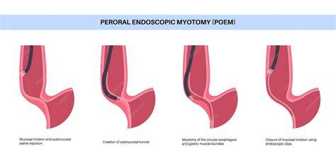 Peroral Endoscopic Myotomy